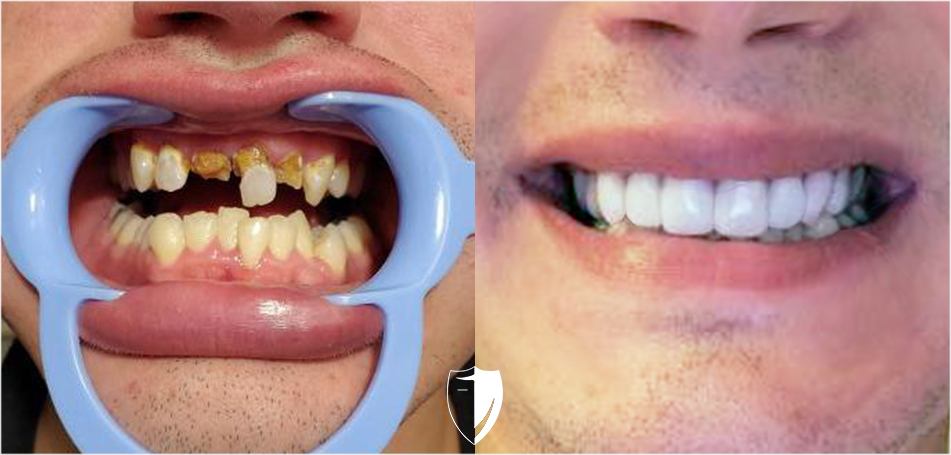 Broken teeth Fix your smile with Bil Veneers from Brighter Image Lab
