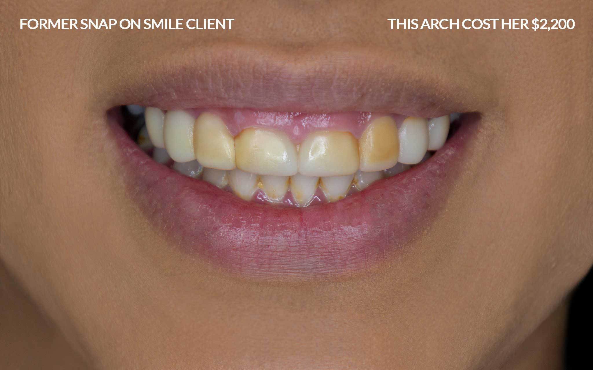Client wearing Snap-On Smile removable veneers