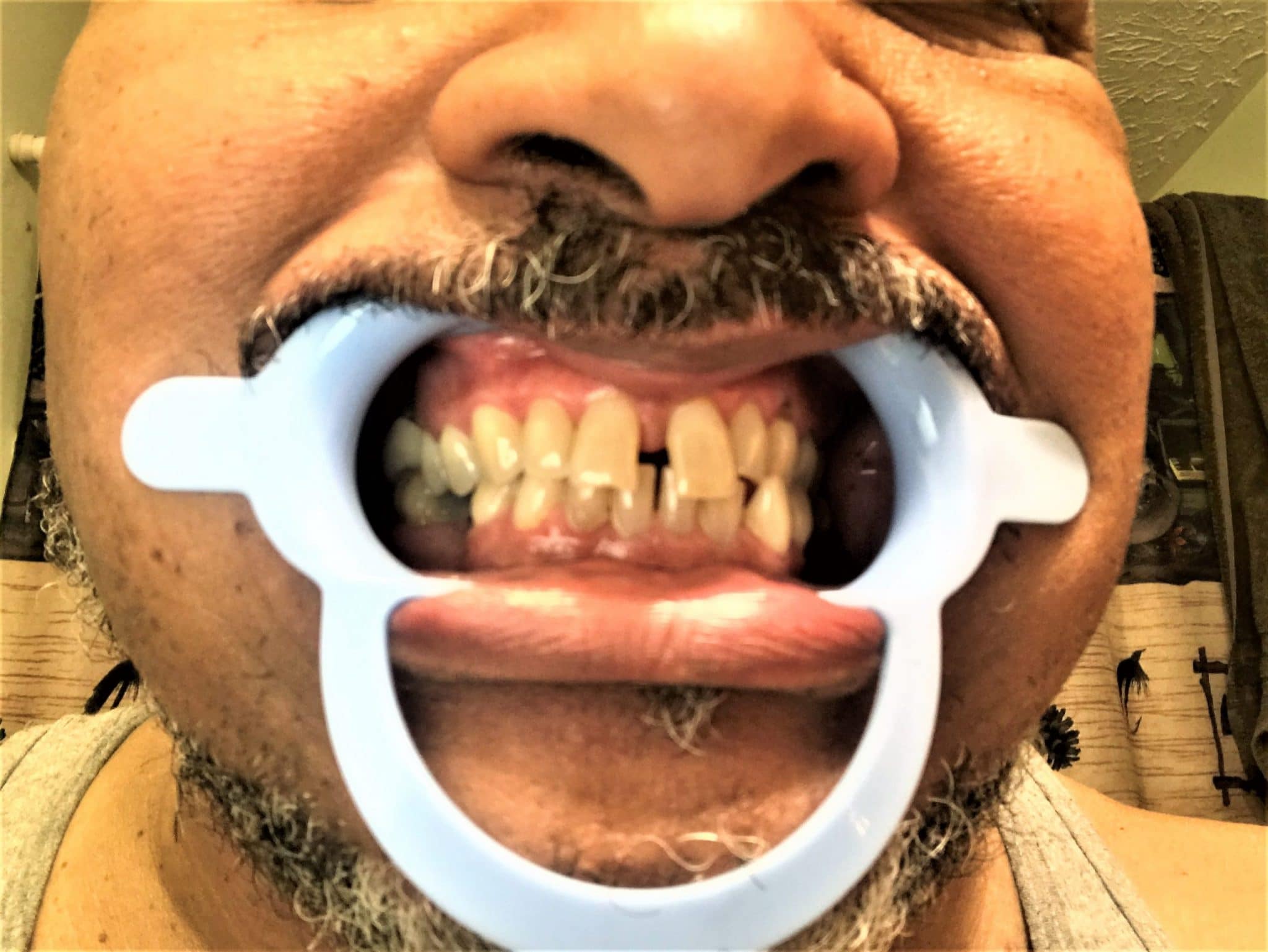gap teeth