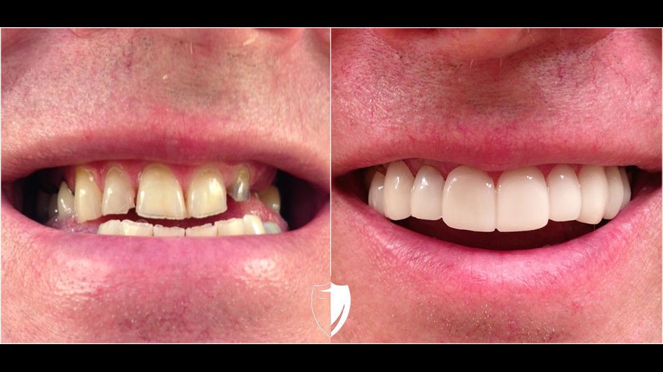How To Get Free Veneers From Brighter Image Lab Veneers Before And After | Brighter Image Lab Gallery [2020]