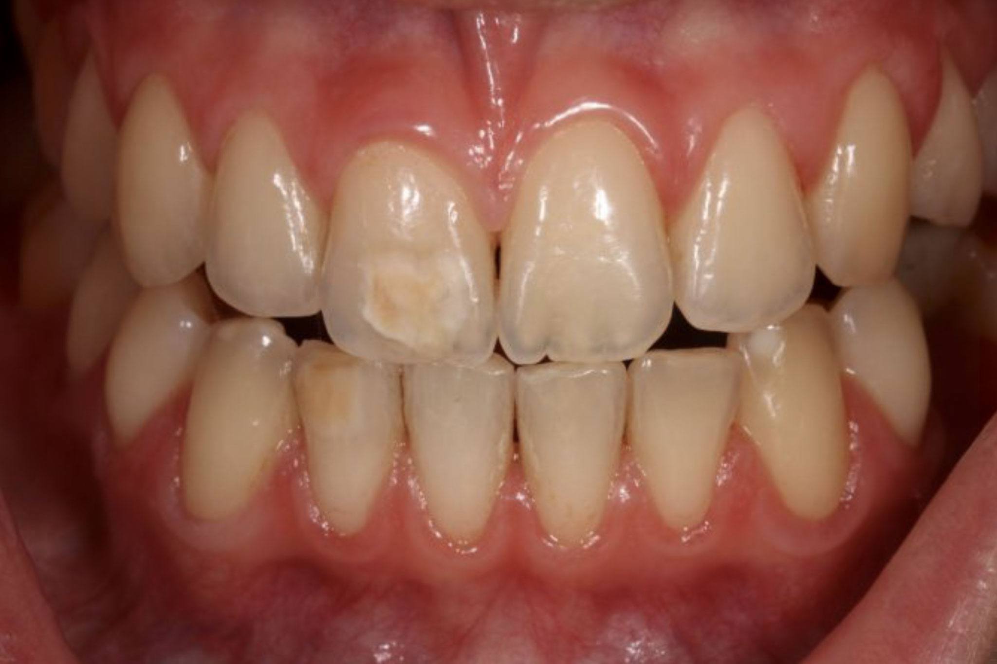 Disgusting Brown Spots on Teeth and a List of 6 Causes