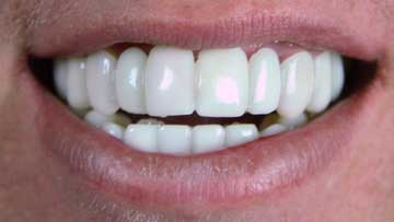 4.snap on dental veneers