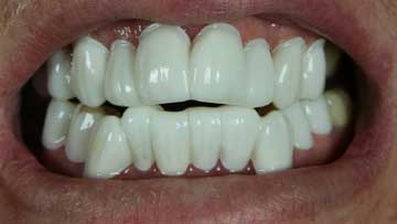 Fake teeth veneers on our client Doug V.