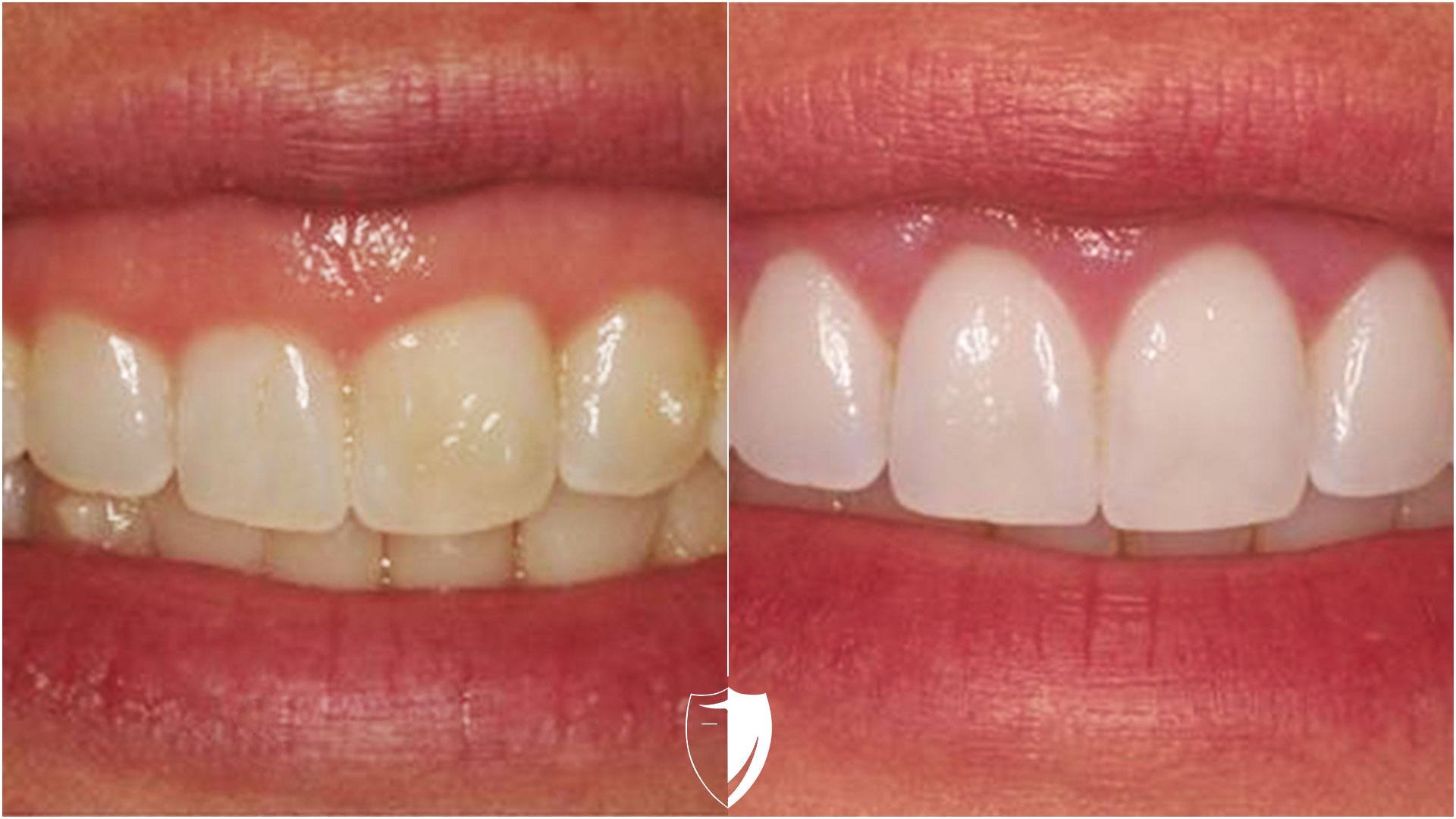 Client photo before and after gum contouring