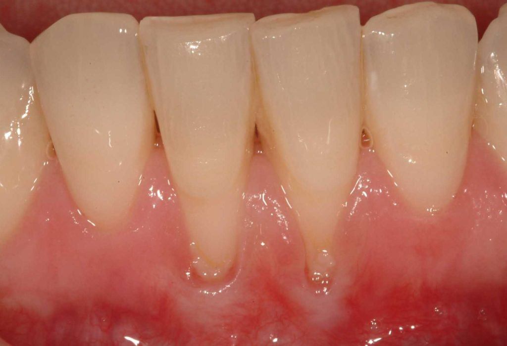 Receding gum lines can be a warning of other oral issues