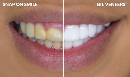 Snap-On Smile vs BilVeneer